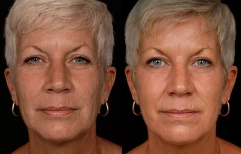 Efekt laserowego leczenia skóry twarzy – redukcja zmarszczek