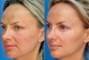 zdjęcie przed i po odmłodzeniu skóry urządzeniem